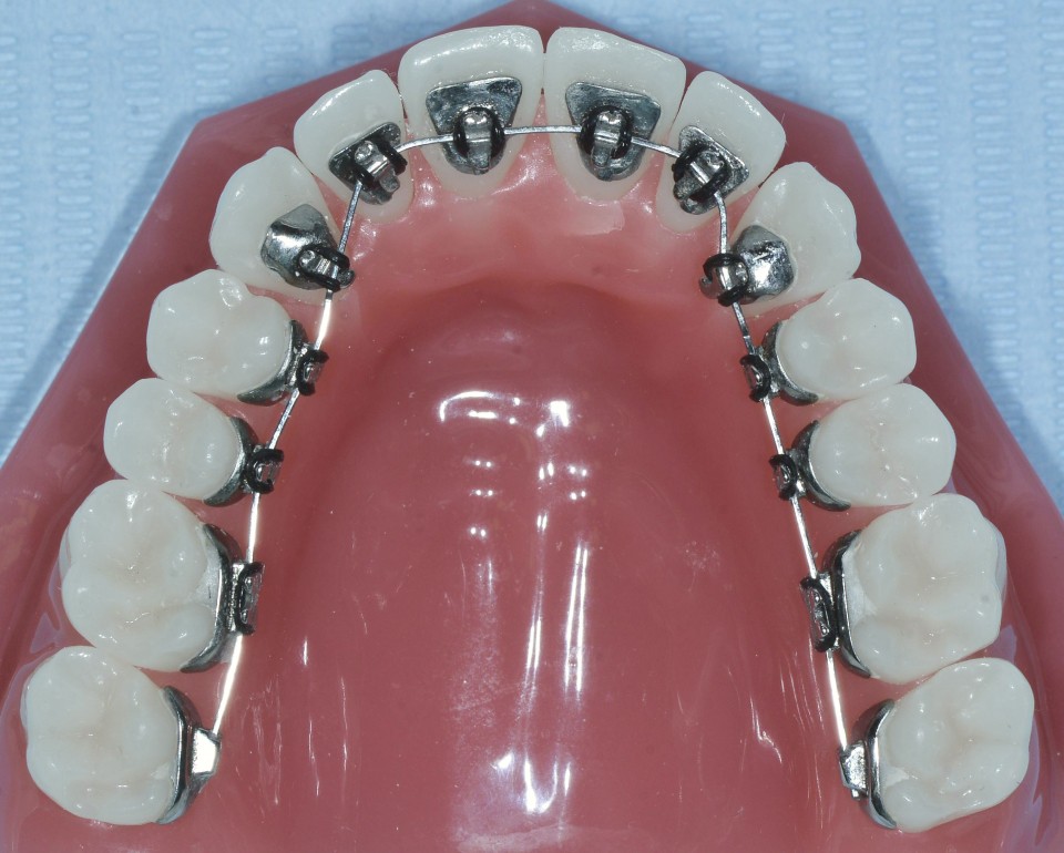 Dr Roy orthodontiste Saint Genis Pouilly orthodontie vis linguale